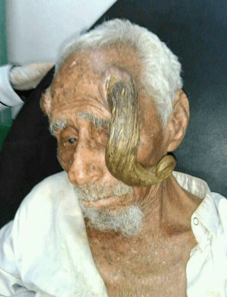 Старик, мужчина, рога, нарост, опухоль