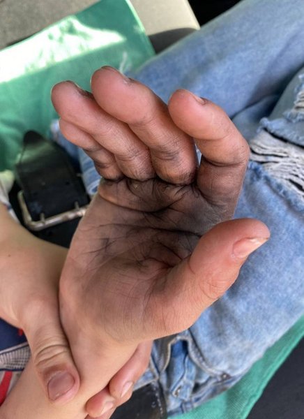 подросток шахед ожоги, взорвалась деталь шахеда