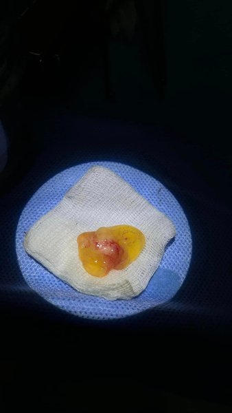 молочный зуб операция