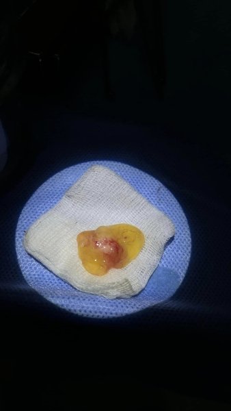 операция на млечни зъби операция на млечни зъби