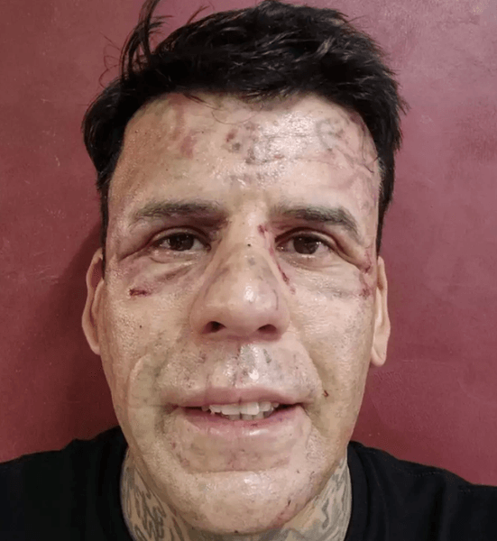 Мужчина с татуировками на лице показал, как выглядит после их удаления с помощью лазера