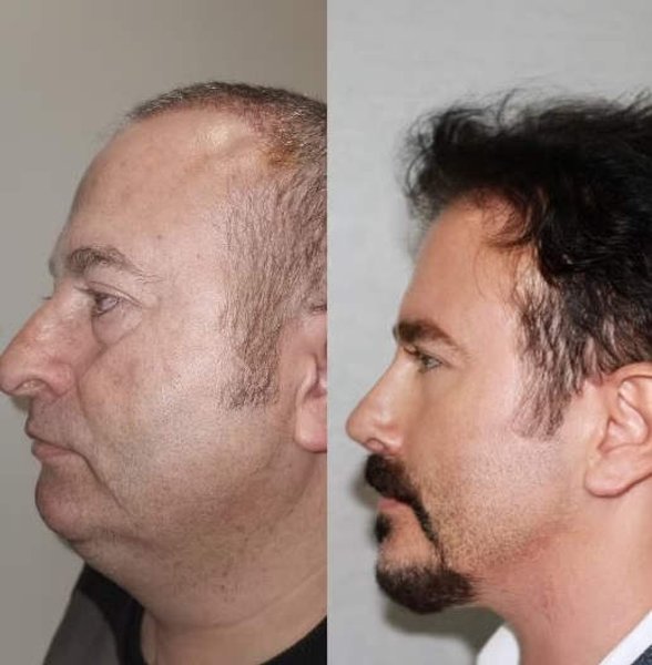 Пластическая операция, операция на лице, фото до и после, клиника, ринопластика, хирург, доктор, внешний вид,
