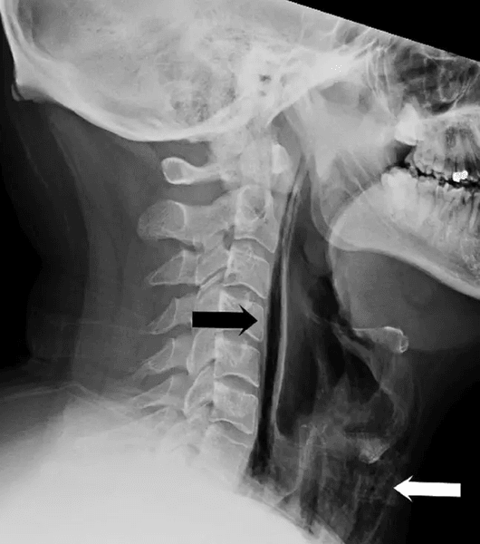 Рентген, снимок горла, чихнул и порвал горло, сдержал сильный чих, изменился голос, спонтанный разрыв гортани