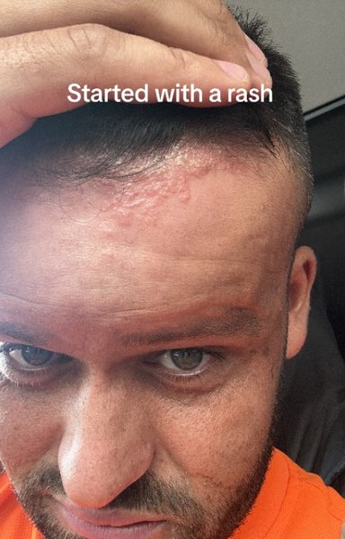 Курйоз в Британії, Ryan Briggs, Раян Брігс, алергія, висип, фарбування фолосся