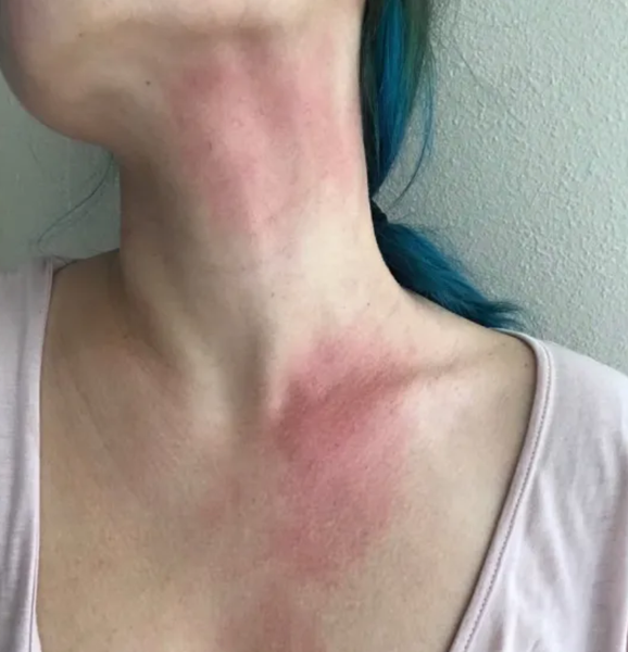 Кому нельзя мыться, гигиенические процедуры, контакт с водой, душ, Лорен Монтефуско, странные диагнозы, фото, США