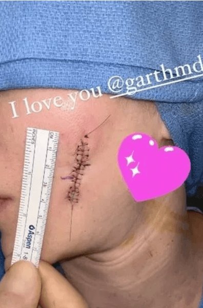 шрам на лице у Хлои Кардашьян