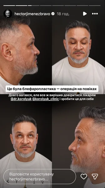 Ектор Хіменес-Браво сделал блефаропластику