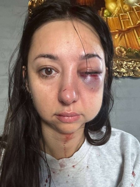 нападающий избитая девушка Избитая Д. Гамбаряном женщина