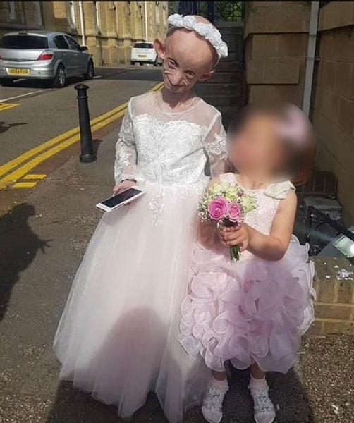 Ашанти Смит, прогерия