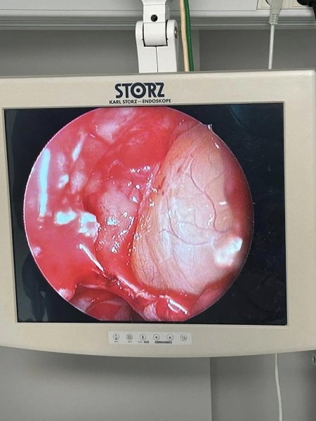 млечен зъб в носа млечен зъб в носа