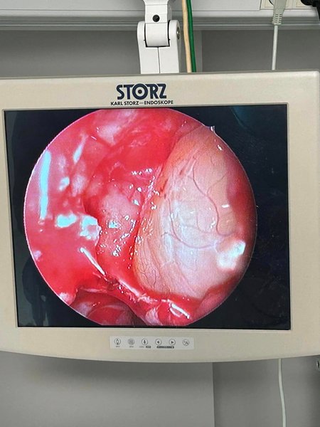 молочный зуб в носу