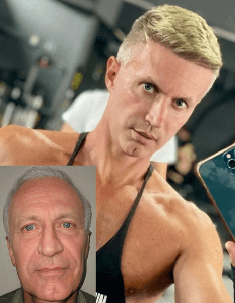 Пластическая операция, до и после, мужчина изменился до неузнаваемости, помолодел на 40 лет, подтяжка лица, ринопластика