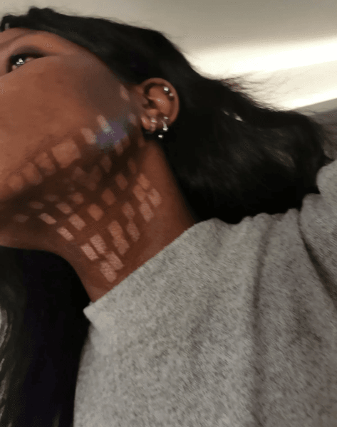 Женщине испортили кожу, лазерная эпиляция, шахматная доска, следы ожогов, ожоги на лице, редкая болезнь, стажер, рост волос