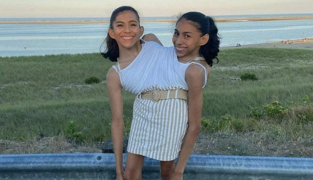 Сиамските близначки Кармен и Лупита Андраде Сиамските близнаци Кармен и Лупита Андраде, как живеят, външен вид, аномалии, мутации, връзки, истории на интересни хора, снимки