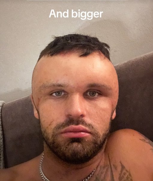 Курйоз в Британії, Ryan Briggs, Раян Брігс, лікування, алергія, набряк