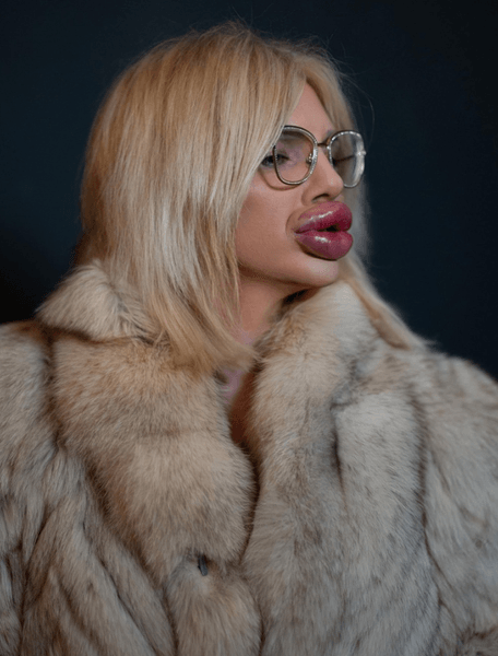 Жінка, яка витратила тисячі доларів на філери для губ