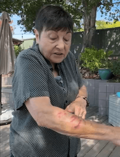 Американка демонструє глибокі подряпини та укуси на руці після агресивного нападу білки