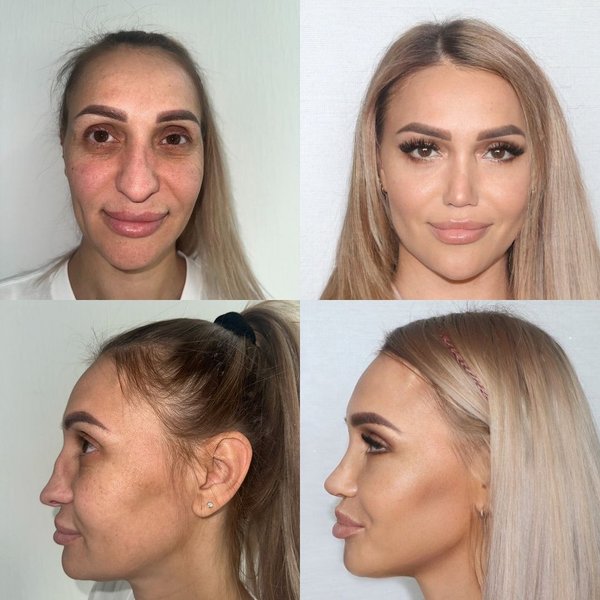 Женщину после пластической операции невозможно узнать, кардинальные изменения во внешности, фото до и после пластики