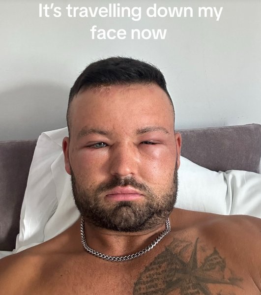 Курйоз в Британії, Ryan Briggs, Раян Брігс, лікування, алергія