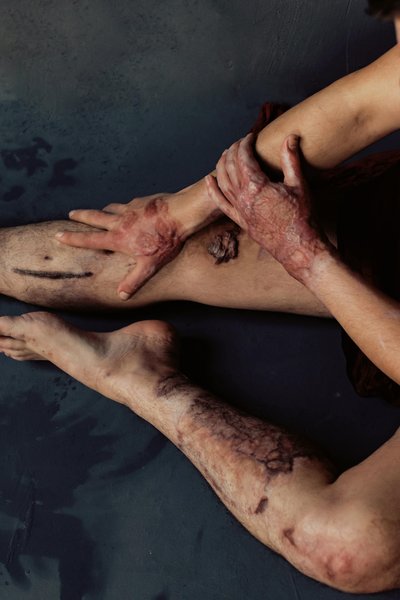 фотографиня Марта Сирко, Марта Сирко інваліди, Марта Сирко ампутація, ампутовані кінцівки, ампутант, поранені бійці