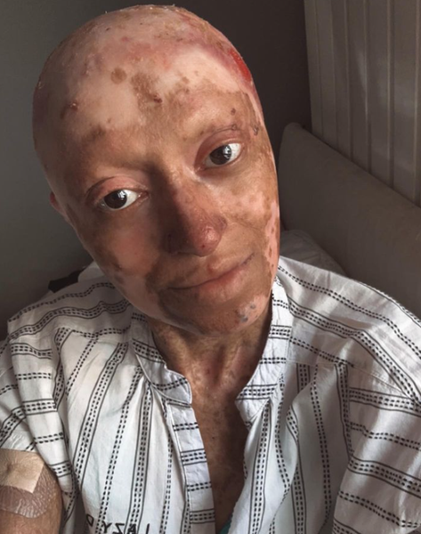 Захворювання шкіри, аномалії, дивні діагнози, зовнішність як Фредді Крюгера, фото, Велика Британія