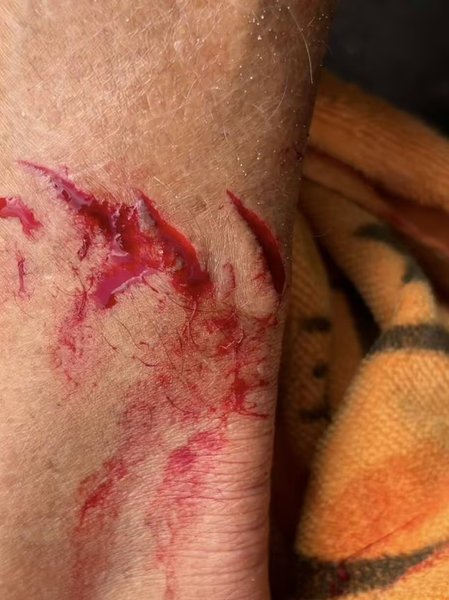 Пригоди серфінгіста, Чарлі Хаєк, укус акули, наслідки