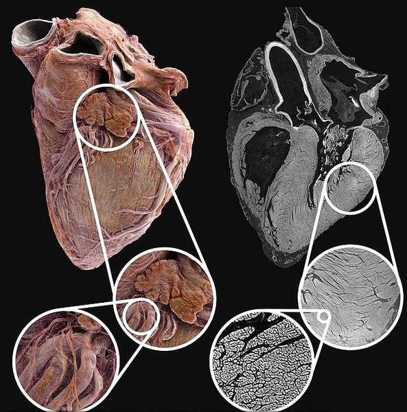 сердце томография