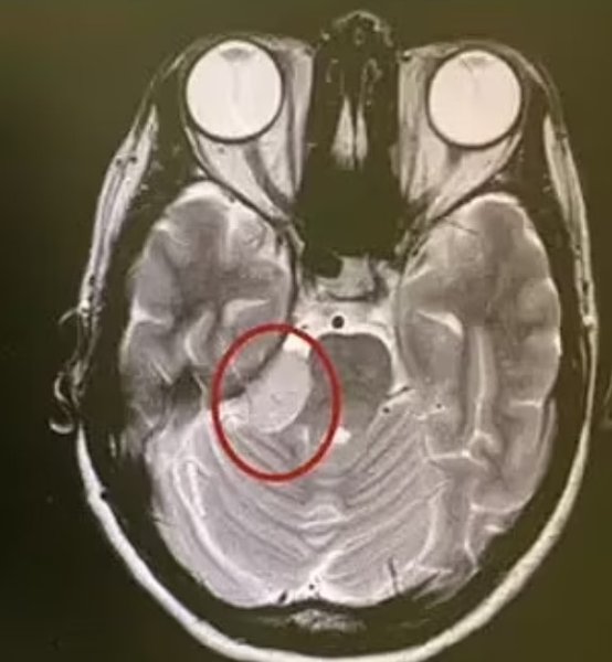 опухоль мозга