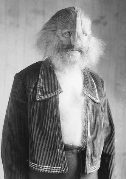 Мужчина с лицом льва, Лайонел, парень с лицом льва, мужчина-лев, цирковой артист, гимнаст, мировая знаменитость, редкое заболевание,