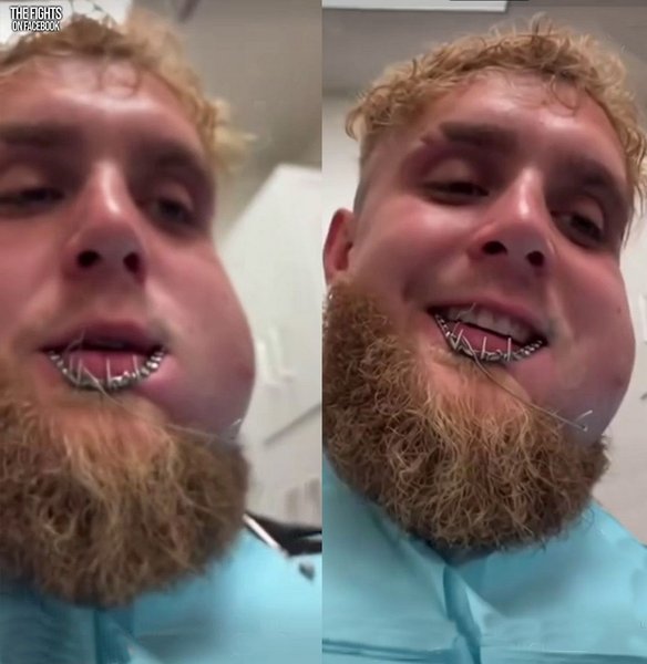 джейк пол зламана щелепа