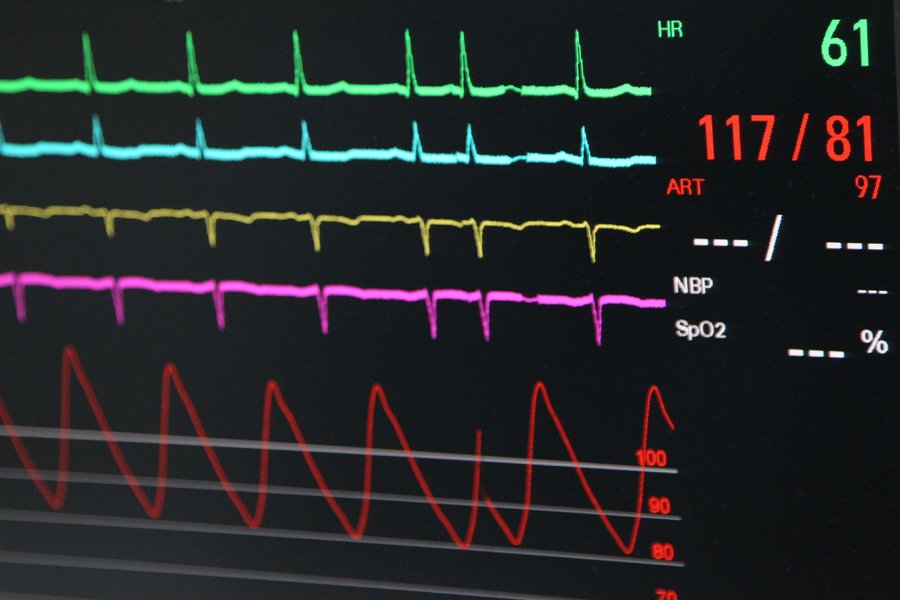 монитор, операция на сердце, кардиограмма