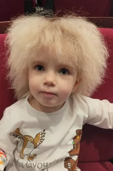 Синдром нерозчесаного волосся, діагноз, захворювання, діти, Велика Британія, фото, аномалії