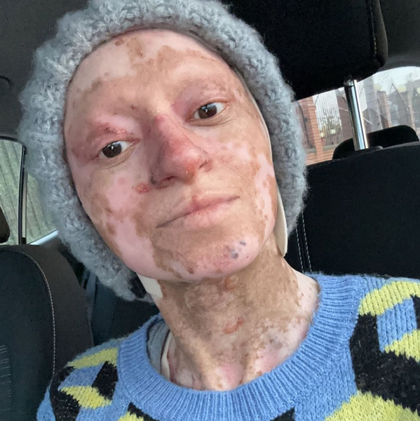 Захворювання шкіри, аномалії, дивні діагнози, зовнішність як Фредді Крюгера, фото, Велика Британія