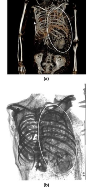 мумія грудна клітка плід