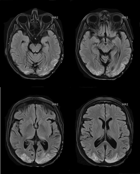 мозок, енцефалопатія, кора, сліпота, коронавірус, ускладнення