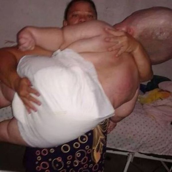 Женщина с большой головой, редкая болезнь, выглядит как младенец, болезнь, огромная голова,