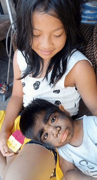 Хлопчик із рідкісним захворюванням, схожий на перевертня, синдром перевертня, гіпертрихоз, рідкісне захворювання, з'їла кішку, прокляття