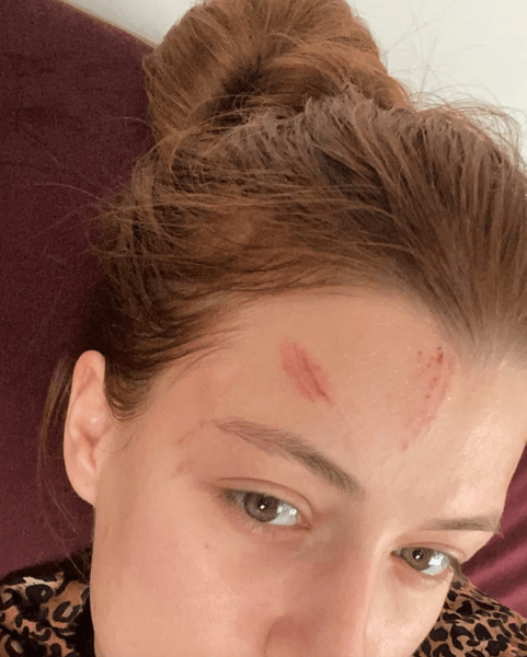 анастасія суббота синці