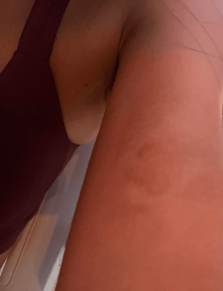 Укус комара, комар, насекомое, курьезы, цвет кожи после укуса насекомого, неизвестное насекомое,