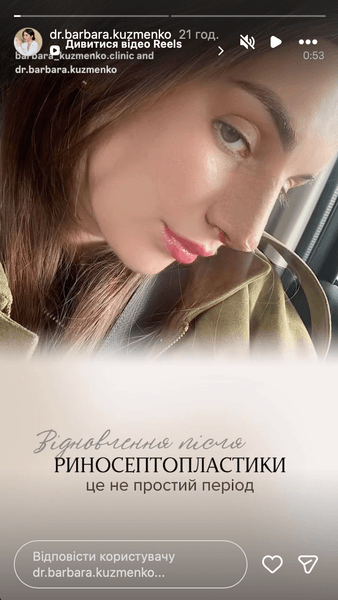 Барбара Кузьменко зробила риносептопластику