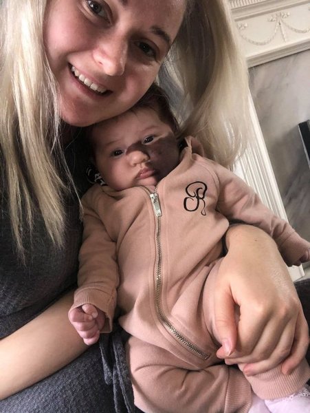 Харпер Кинг, ребенок, родимка