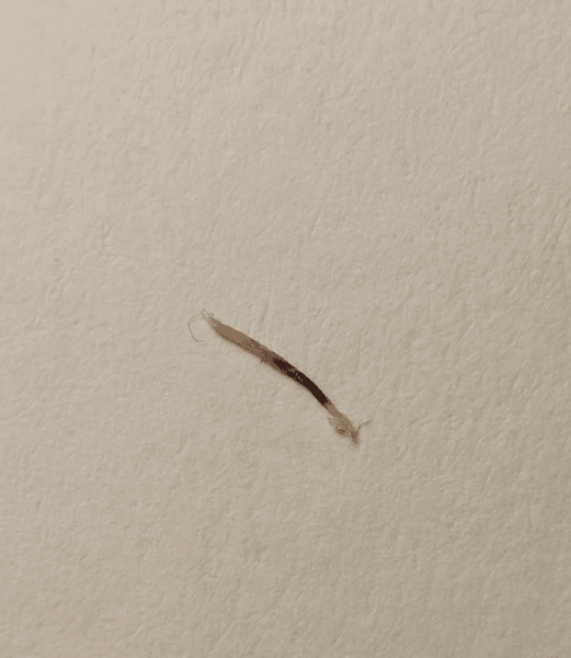 Головний біль, дістав із голови, незвичайний предмет, схоже на ріг, незвичайна знахідка, волосся, волосся, шкірний ріг, соцмережі