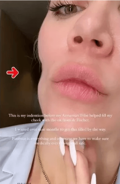 вмятина на лице у Хлои Кардашьян