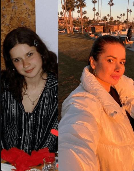 Аліна Шаманська до і після пластики