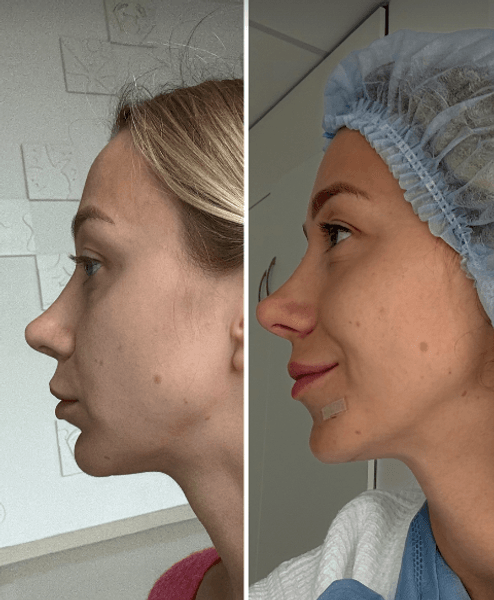 Жена Виктора Павлика сделала липофилинг