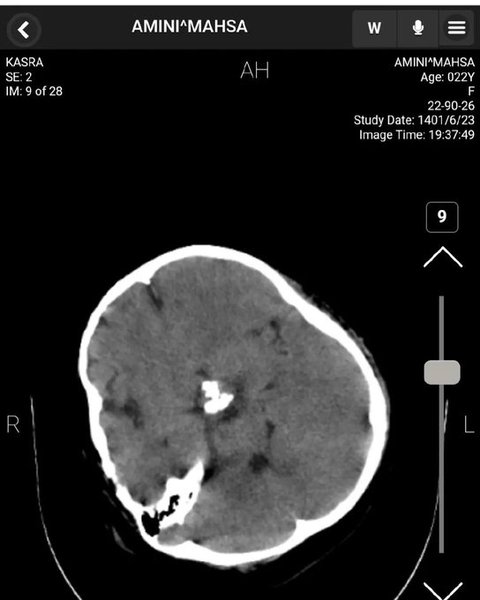 мозок, голова, КТ, Махса Аміні