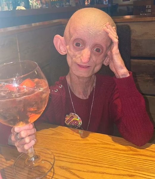 прогерия, девушка, болезнь