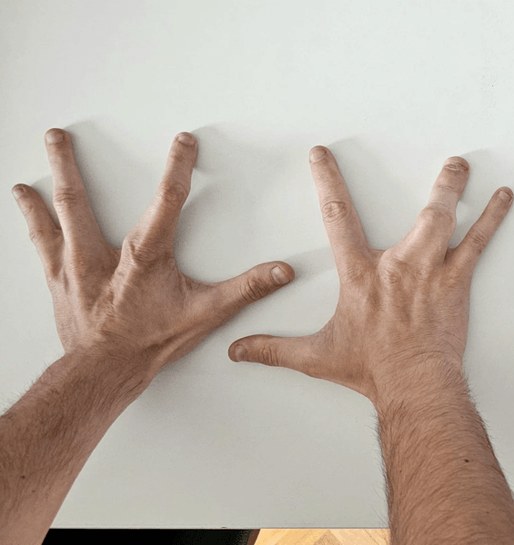 Мужчина родился с четырьмя пальцами на руках, четыре пальца на руке, генетическая лотерея, операция на руке, нет среднего пальца