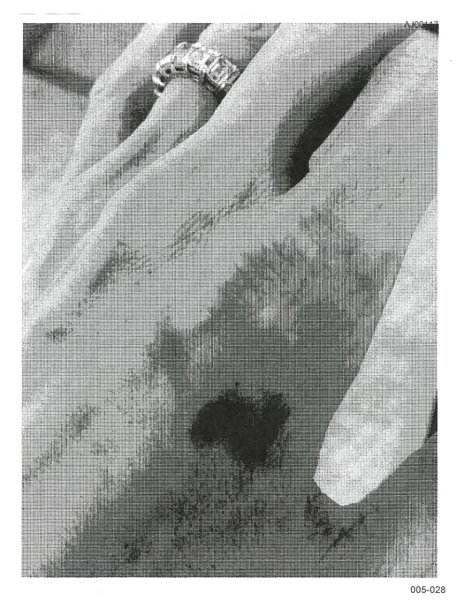 натъртване на ръката на Джоли Джоли