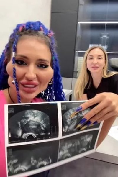 Анастасія Покрещук, українка з найбільшими у світі вилицями, пластичні операції, зовнішність, епатаж, фото